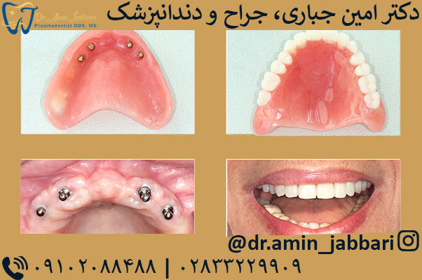 ایمپلنت-تمام-دهان