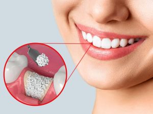 پیوند استخوان در ایمپلنت دندان