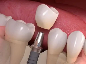 آبسه لثه بعد از ایمپلنت