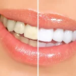 ماندگاری بلیچینگ دندان